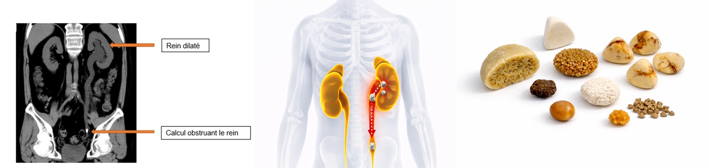 sos calculs - hôpital aubagne-marseille